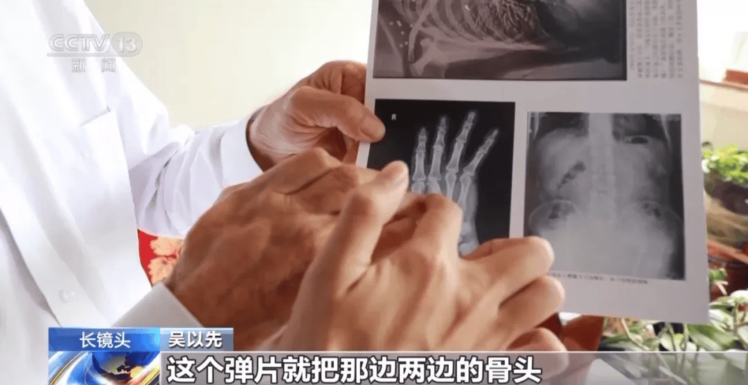 皇冠登一登二登三区别_“老先生皇冠登一登二登三区别，您把项链取下来再做CT”